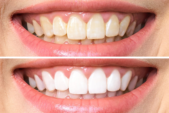 ojas-before-after Best dental clinic in theni